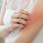 Allarme acne, prurito e secchezza in autunno: le soluzioni di skin care più efficaci